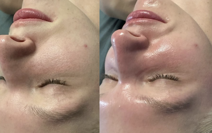 HydraFacial before and After IG