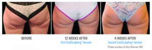 CoolSculpting Before After Woman Buttocks Banana Roll