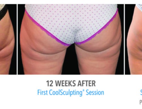 Coolsculpting vs. Liposuction – Which is Best for You?