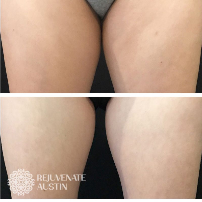 Cool-4-2 Before & After Legs