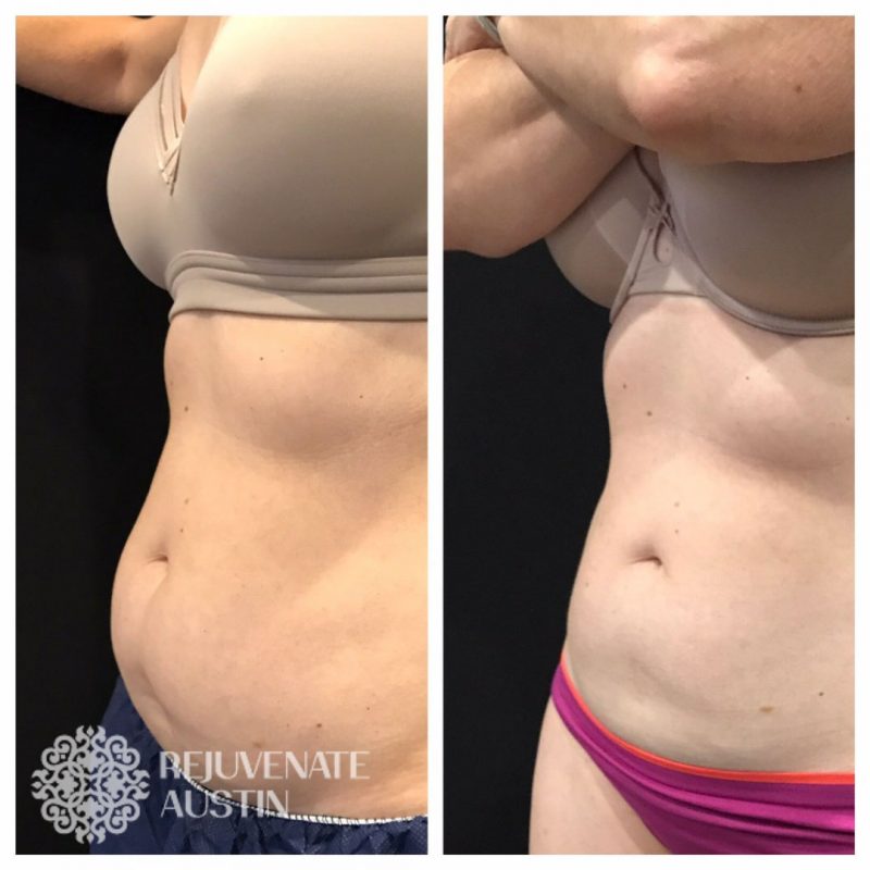 Cool-4-3 Before & After Belly 4