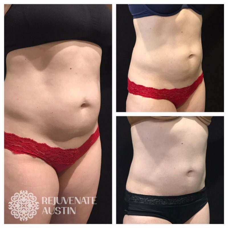 CoolSculpting Before & Afters