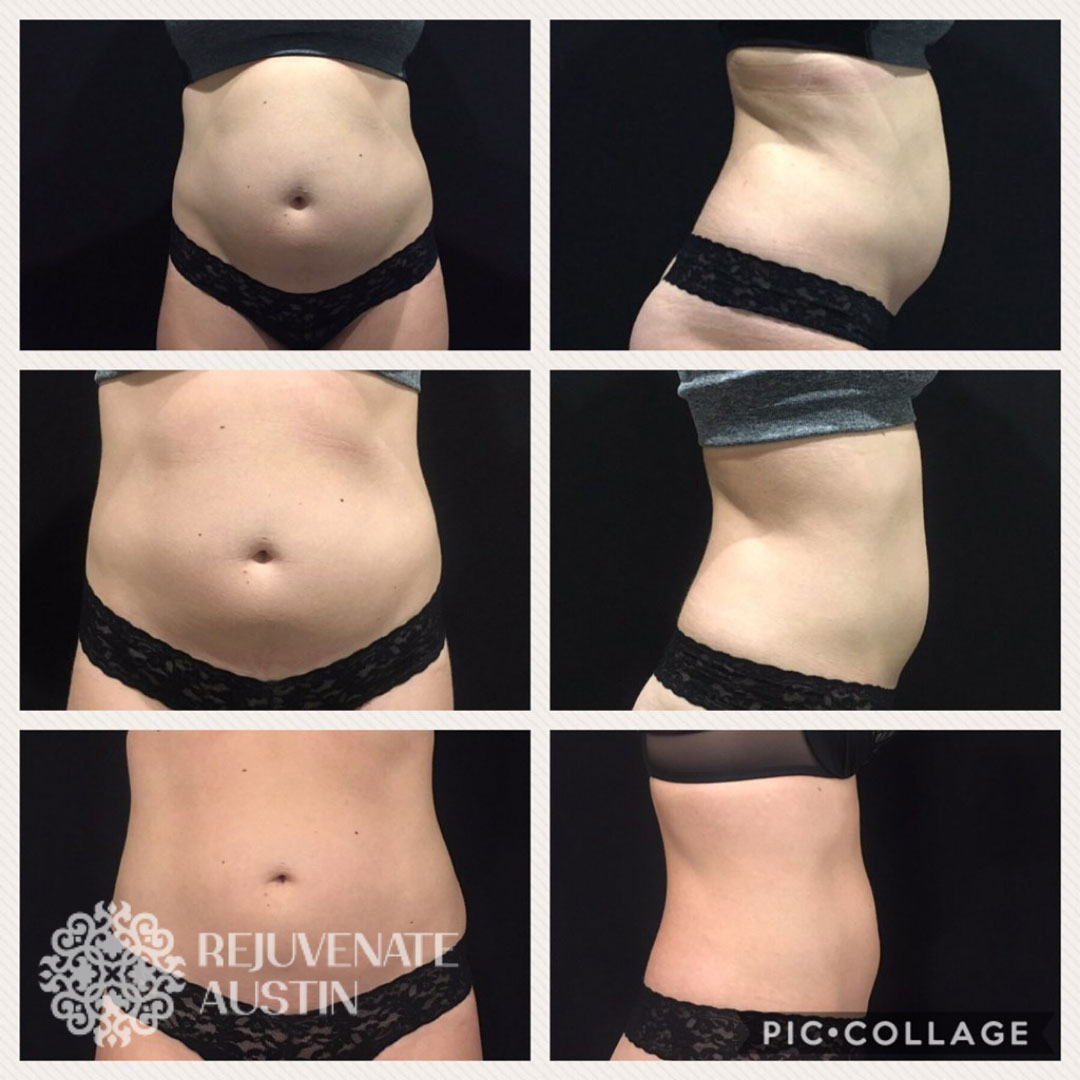 Before & After Belly 2