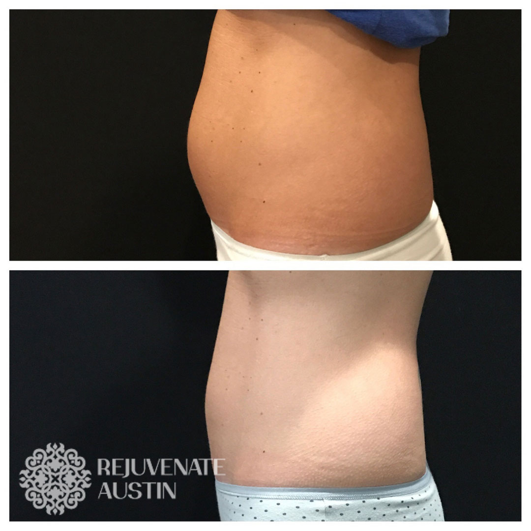 Before & After Belly 5