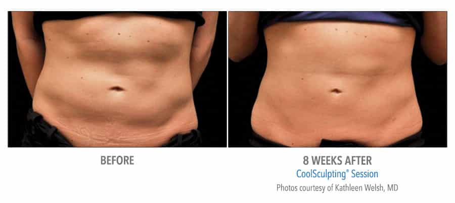 CoolSculpting Before After Woman Abs 8 Weeks