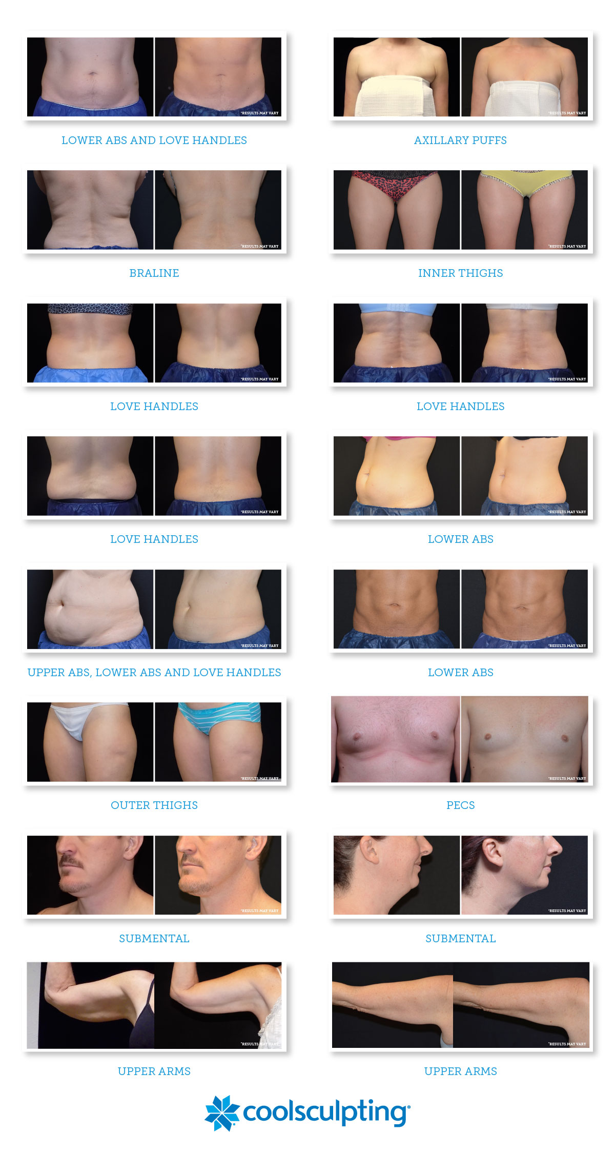CoolSculpting Before and Afters