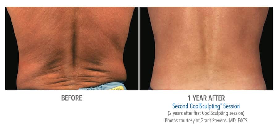 CoolSculpting Woman Before and After
