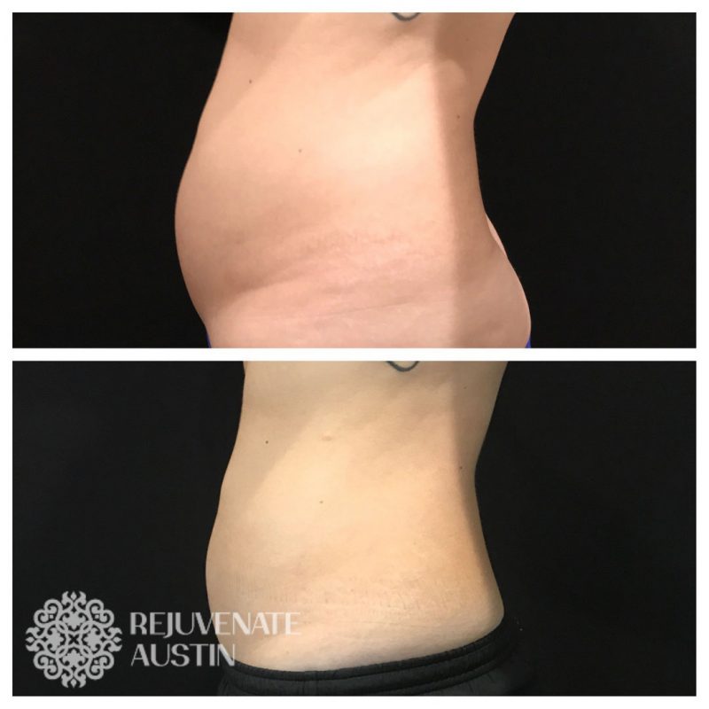Coole3-2 Before & After Belly 1