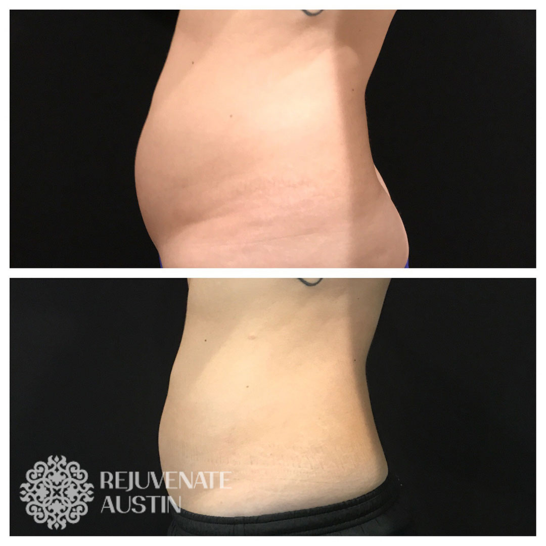 Before & After Belly 1
