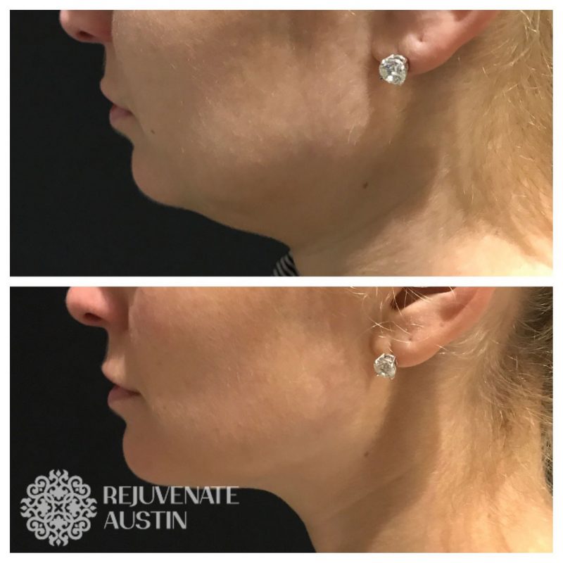 Before & After Neck