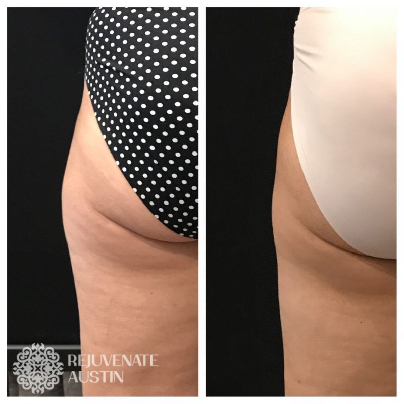 Copy-of-July-Specials Before & After legs