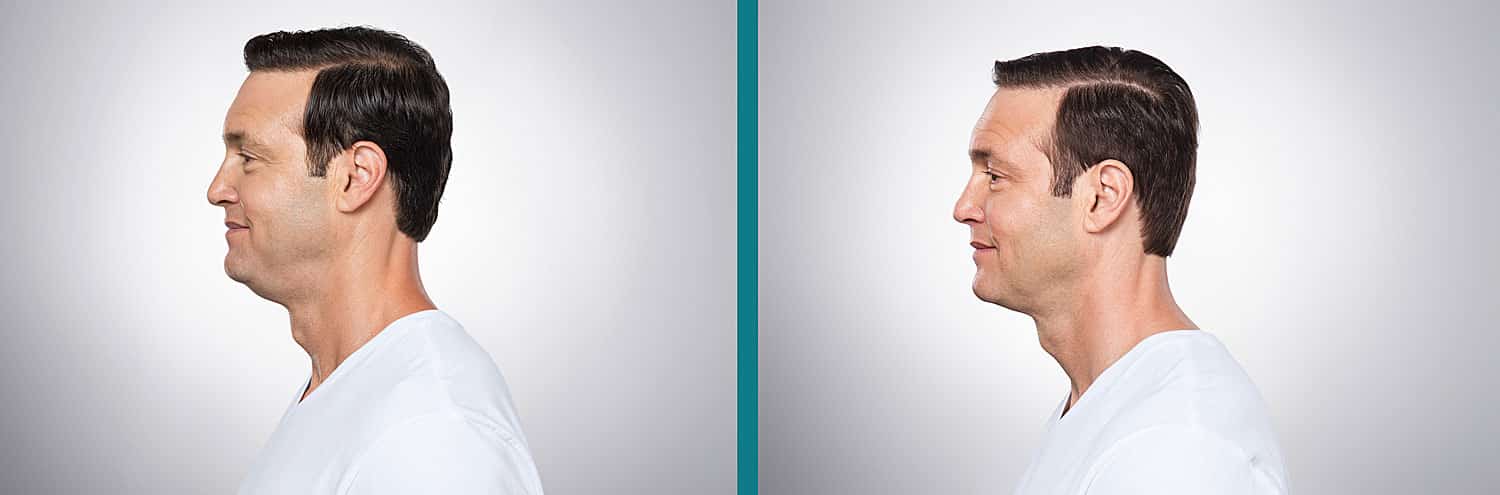 Kybella Before and After Man