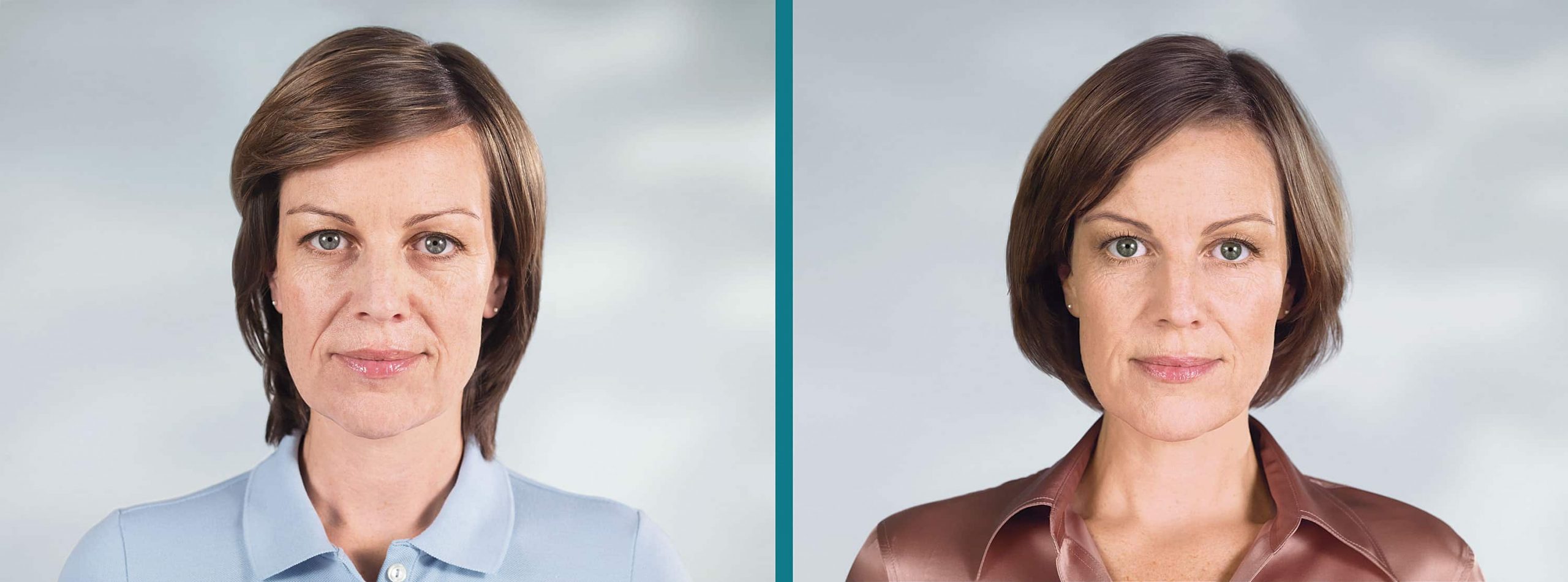 Franca_Before-and-After Sculptra Aesthetic Before and After Woman