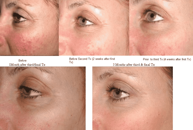 Skin Rejuvenation Before and After