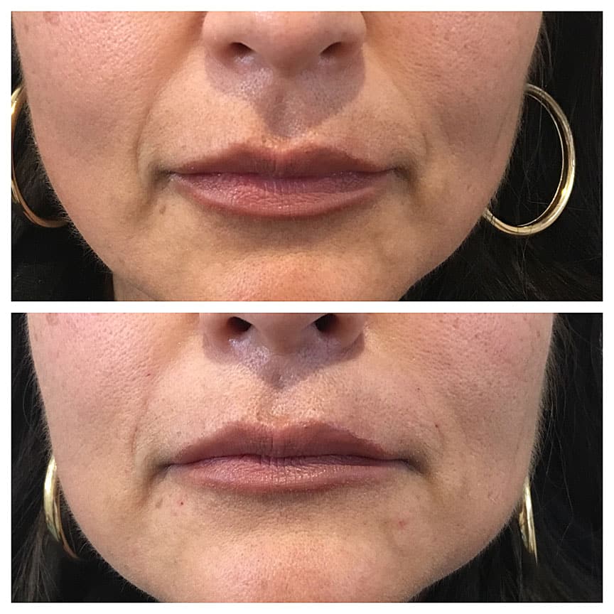 Restylane Before and After