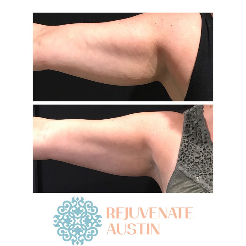 arm-fat Before & After Arms