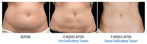 CoolSculpting Before and After Belly