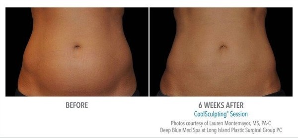 ij07beautyjpg-796fc47981b39a0e CoolSculpting Before and After
