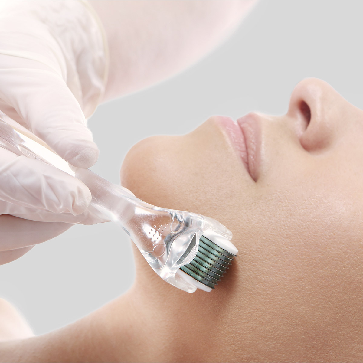 Microneedling Procedure