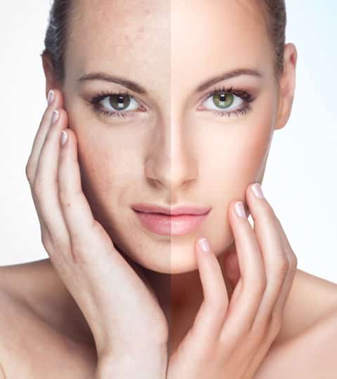 Ipl Photofacial Before and After