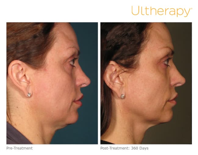 Ultherapy Before & After 360 days