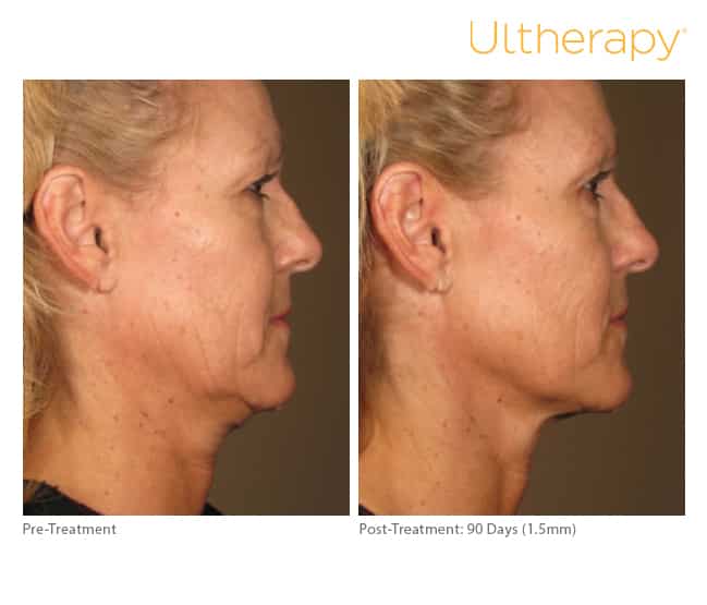 Ultherapy Before & After 90 days