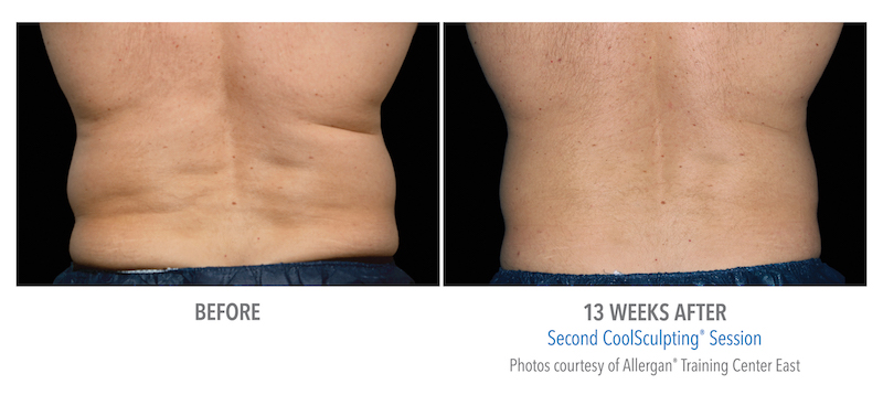 male before and 13 weeks after of coolsculpting session