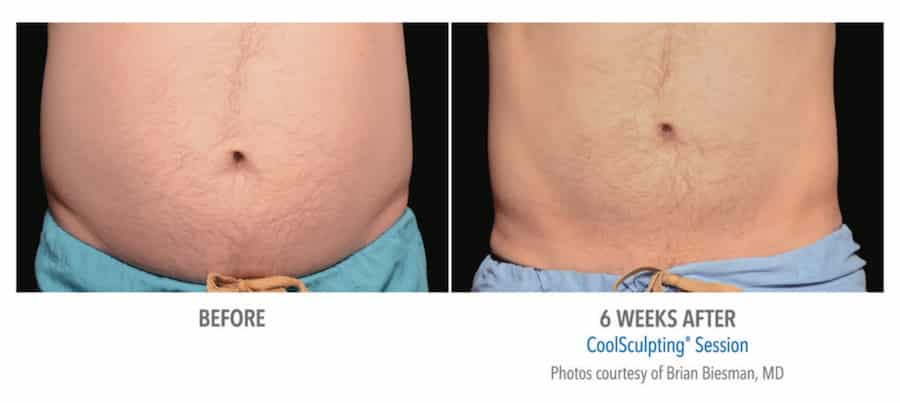 male before and 6 weeks after of coolsculpting session