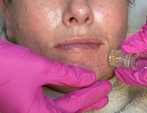 The AquaGold Facial Treatments