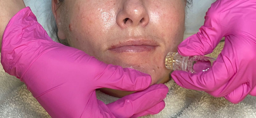 aquagold facial actual patient