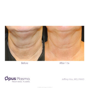 opus-plasma-treatment-neck