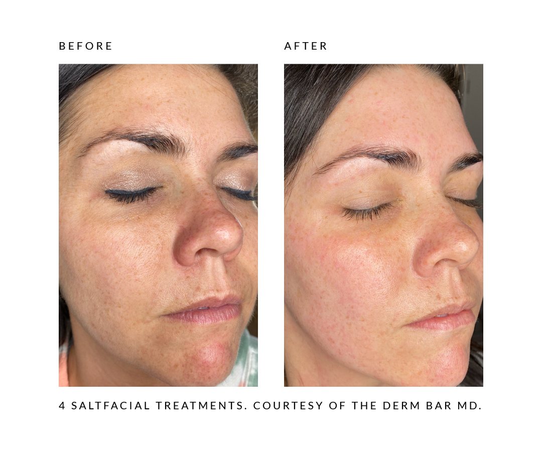 saltfacial MD derm bar
