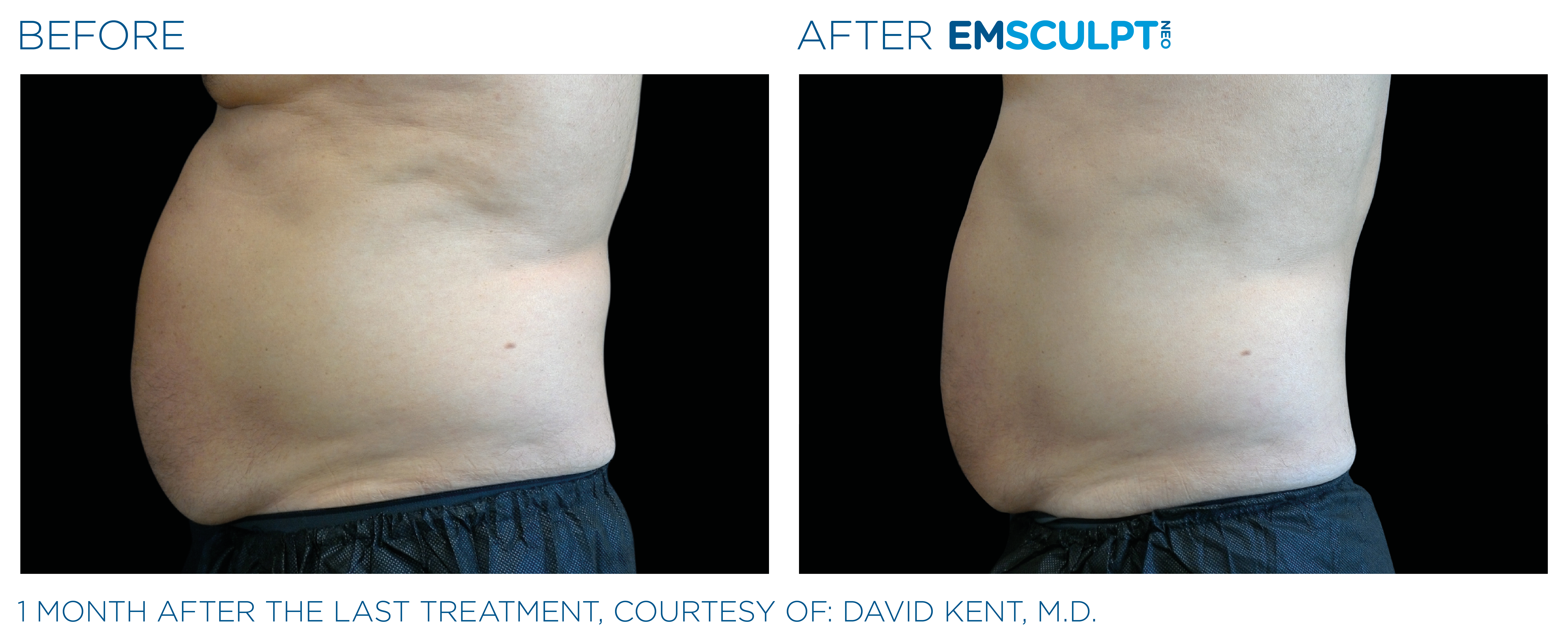 Emsculpt_neo_PIC_Ba-card-male-abdomen-002_ENUS100