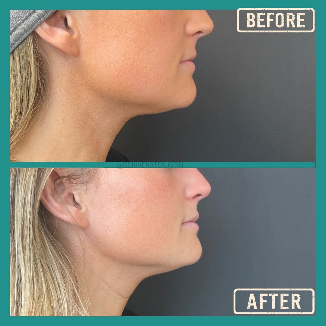 Dermal Filler Radiesse Before and After