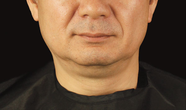 Coolsculpting Male chin before