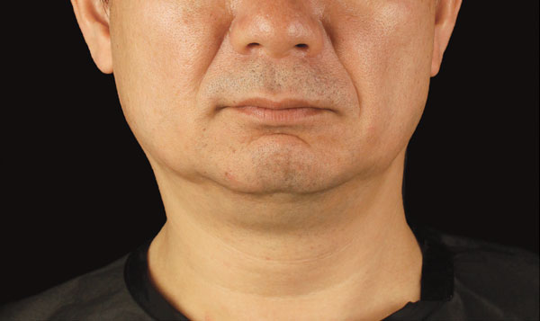 Coolsculpting chin male after