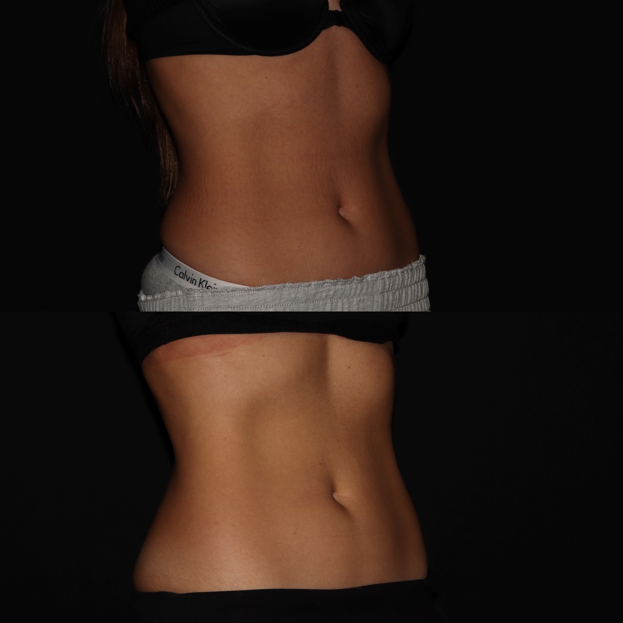 Emsculpt B:a