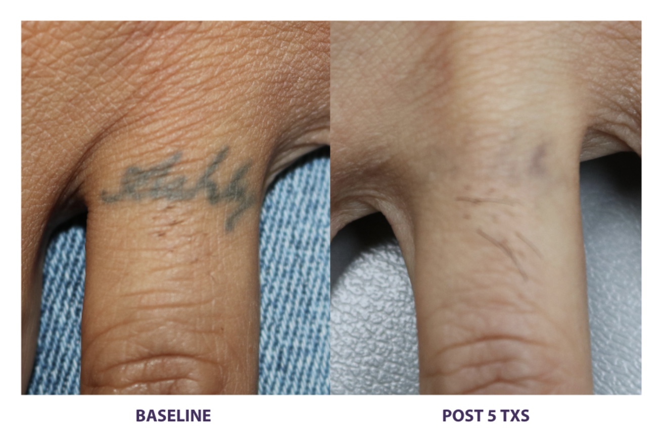 Tattoo Before and After Tattoo Before and After
