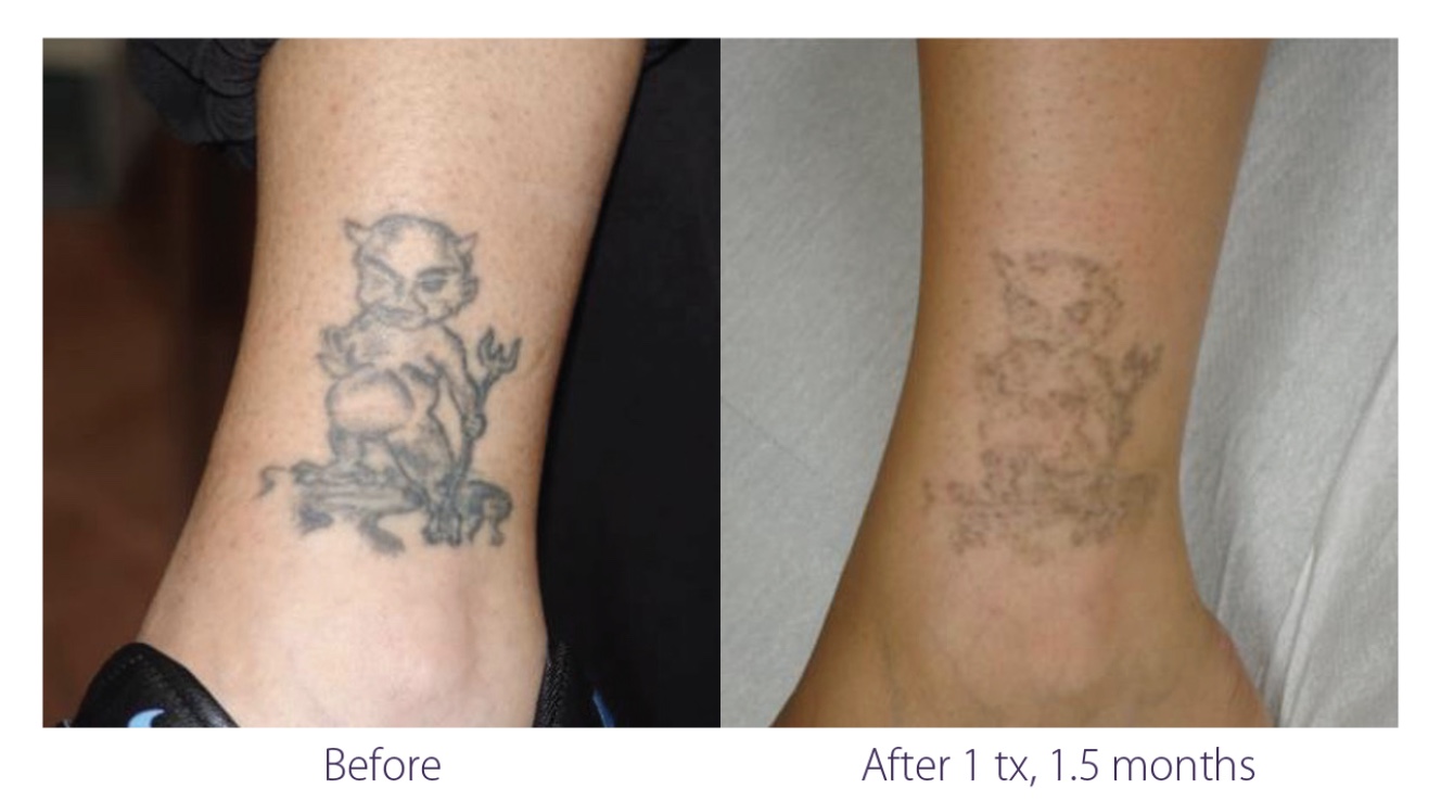 Tattoo before & after 1 tx