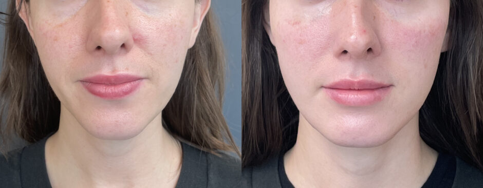 Facial Balancing: Enhancing Your Natural Beauty Without the Overdone Look