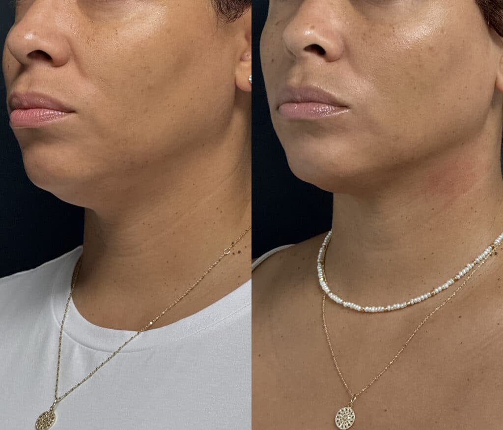 Ultherapy: A Non-Invasive Solution for Skin Tightening and Lifting