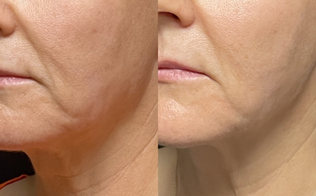 ultherapy close up