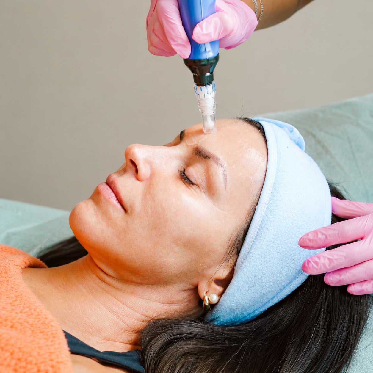 Microneedling